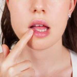 Liječenje herpesa na usnama u jednom danu