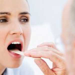 Liječenje oralne kandidijaze u odraslih