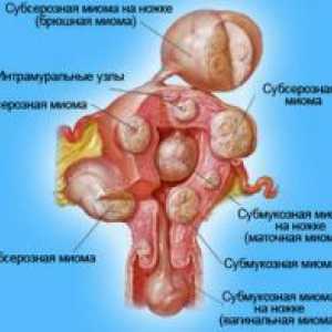 Uterine fibroids - obrada narodnih lijekova