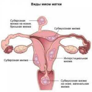 Maternice tijelo uterusa