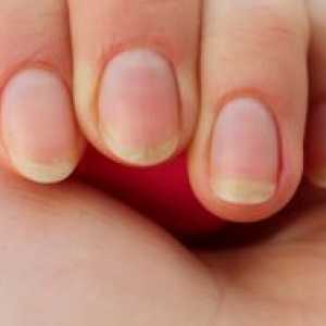 Lomljivi nokti - uzroci