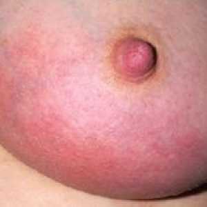 Mastitis dojenje - Simptomi