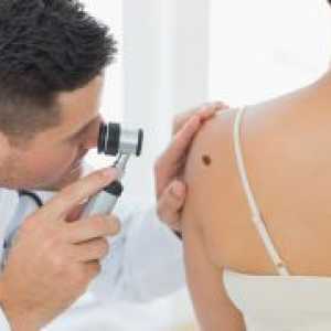 Kožni melanom - život prognoze