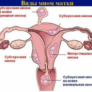 Uterine fibroids - što je to?