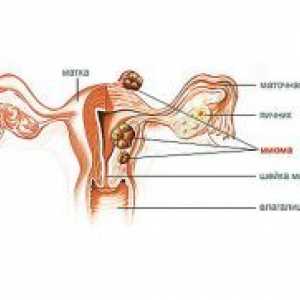 Uterine fibroids male veličine
