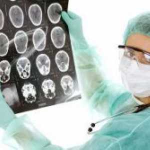 Tumor na mozgu - simptomi u ranim fazama