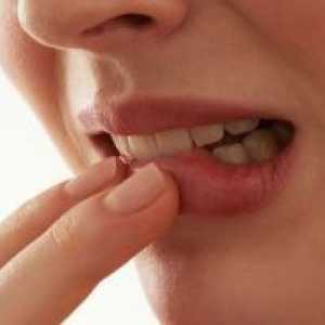Parodontitis - liječenje