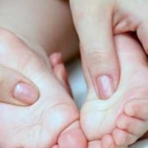 Ploskovalgusnye stopala u djece - liječenje