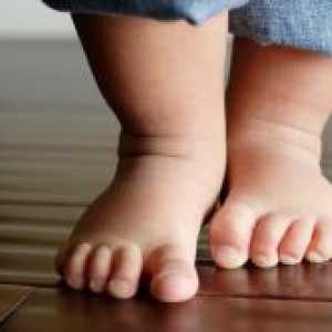 Ploskovalgusnye stopala u djece