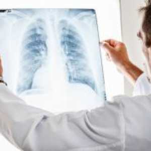 Pneumotoraks pluća