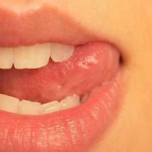 Zašto perleches pojavljuju na usnama?