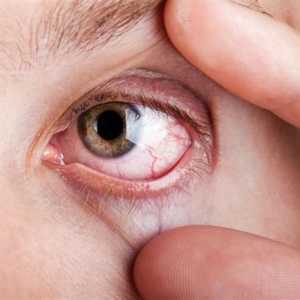 Uzroci i liječenje oka crvenilo