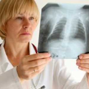 Sarkoidoza pluća - simptomi