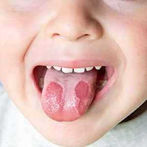Stomatitis u djece