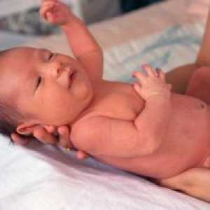 Toksični eritem novorođenče