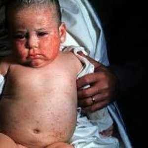 Toksoplazmoza u djece