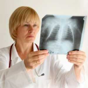 Tuberkuloza - Simptomi