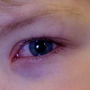 Dijete ima crvene oči, zašto i što učiniti?
