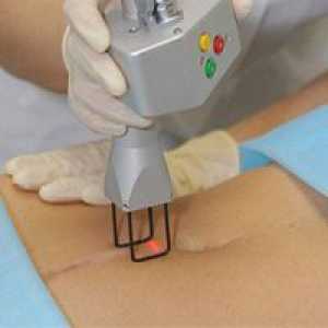 Lasersko uklanjanje ožiljaka