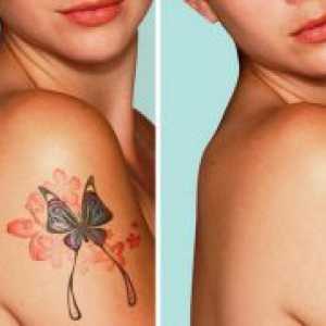 Uklanjanje tetovaža laserom