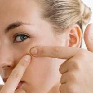 Akne na licu - Liječenje