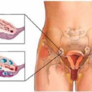 Povećanje jajnika u žena - uzroci