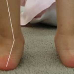 Valgus stopala deformacija kod djece