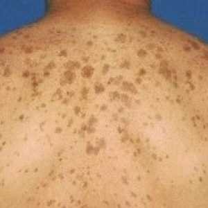 Vrste pigmentnih mrlja na koži i njihovom liječenju