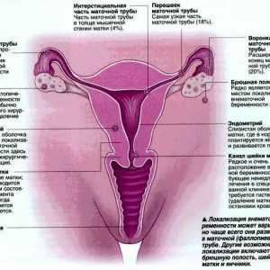 Izvanmaternične trudnoće
