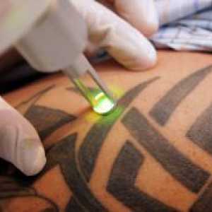 Povlačenje tetovaže