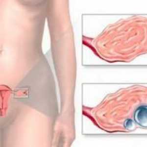 Bolest jajnika u žena