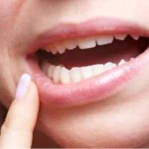 Bolesti oralne sluznice