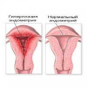 Žljezdane hiperplazije endometrija
