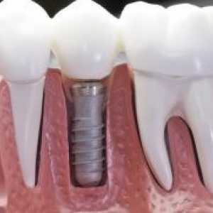 Dentalni implantati - „za” i „protiv”